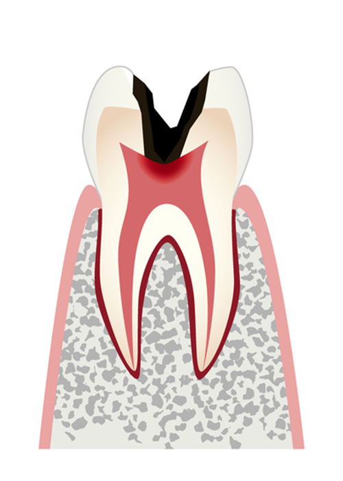 歯髄にまで進行した虫歯